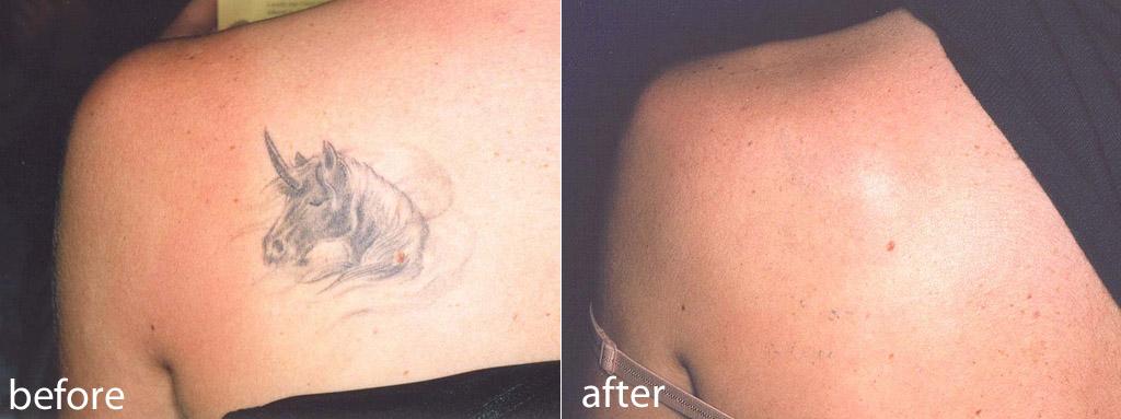 New At Home Tattoo Removal Method uses Natural Products to ...