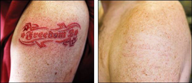 Get Rid Tattoo Natural Removal Review Home Tattoo Removal ...