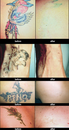 ... Tattoo Removal Method uses Natural Products to Remove Unwanted Tattoos